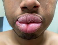 Card illustration for DWII on granulomatous cheilitis
