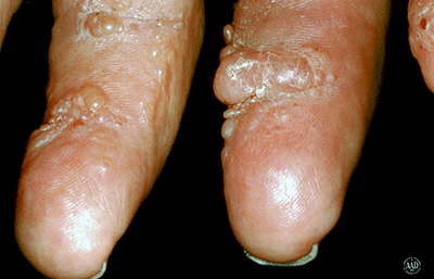 Nodules of systemic amyloidosis on fingers
