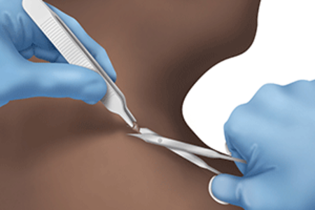 Dermatologist performs snip skin biopsy