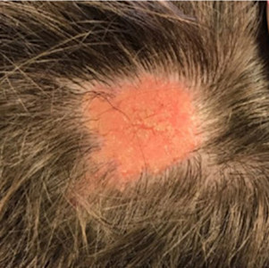 Card illustration for DWII on nevus sebaceus
