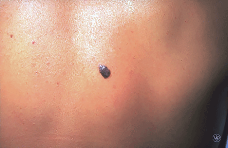 Close-up of a melanoma that resembles a firm, raised growth