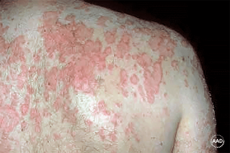 Subacute cutaneous lupus rash on back