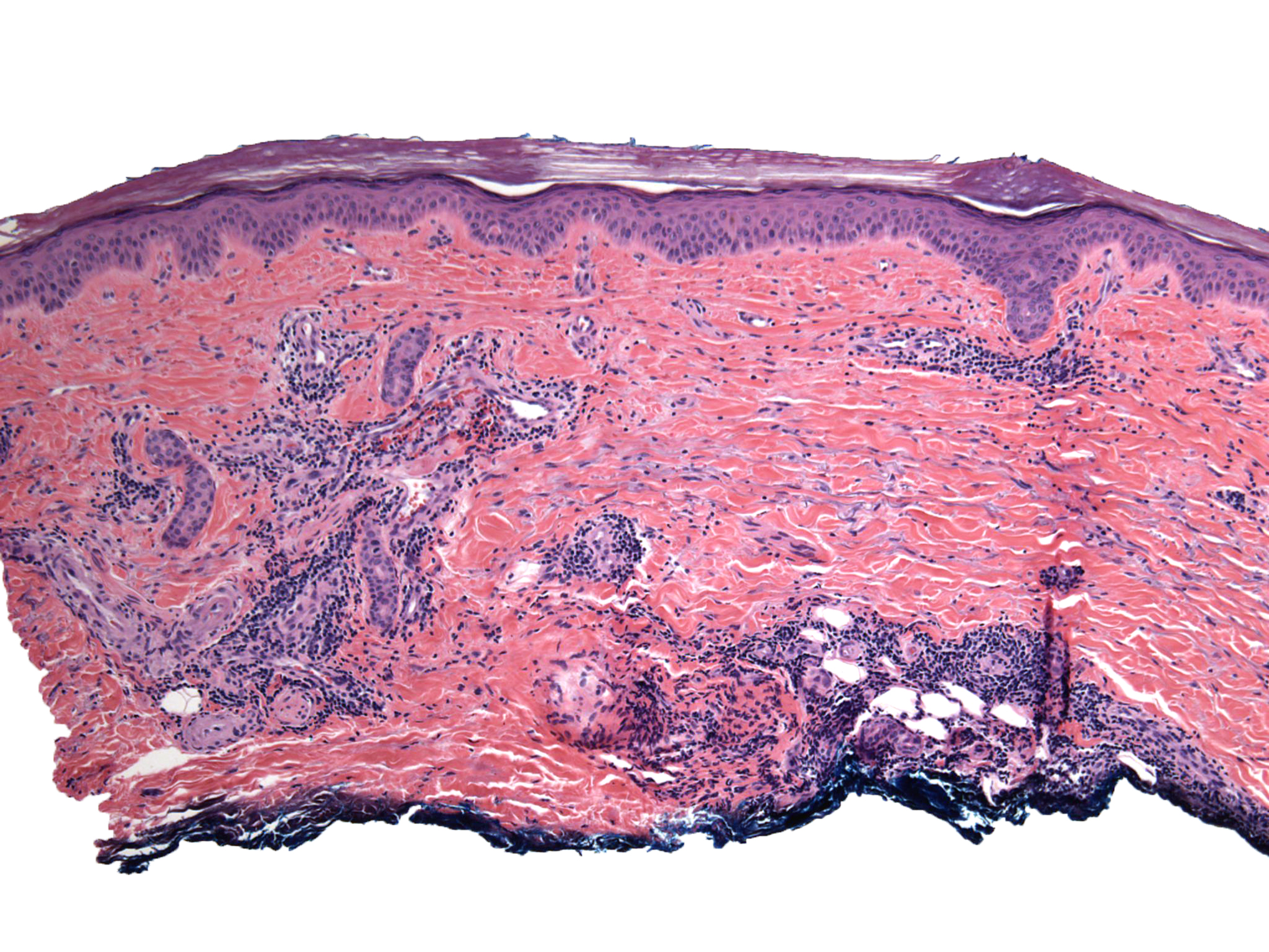 Image for derm manifestations of covid-19 in vmx news