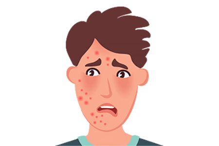 Illustration of a teen boy with severe acne