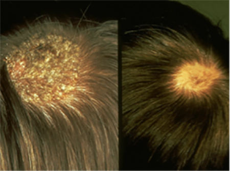 two pictures of scalp with ringworm
