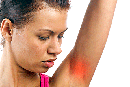 A woman with sore skin in her armpit.