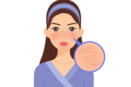 Illustration of woman with red blotchy cheeks