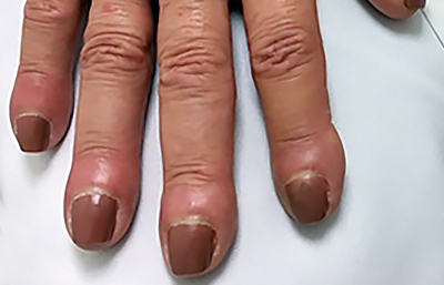 Clubbing causes nails to curve down