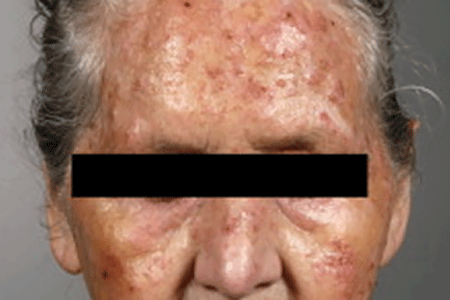 Several spots on this woman's forehead, nose, and cheeks are actinic keratoses