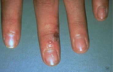 Herpes simplex sores on hand