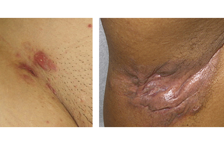 Pictures of early and advanced Hidradenitis suppurativa.