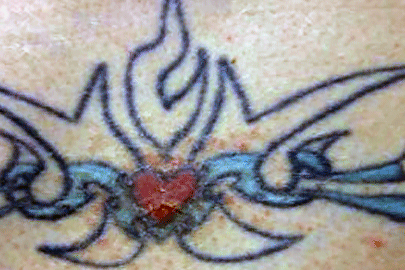 Image of tattoo and allergic reaction
