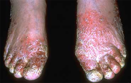 severe stasis dermatitis