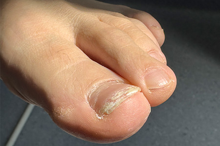 Nail fungus has caused buildup beneath the nail and the nail to lift up.