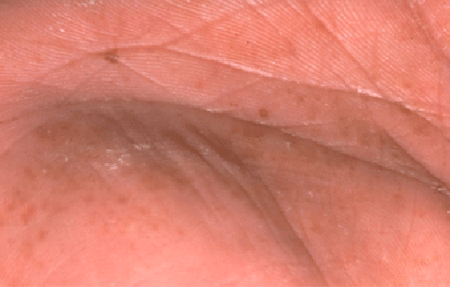 Dyshidrotic eczema on palm of hand