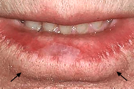 The color in this man's lower lip has disappeared, a sign of a precancerous skin condition called actinic kearatosis