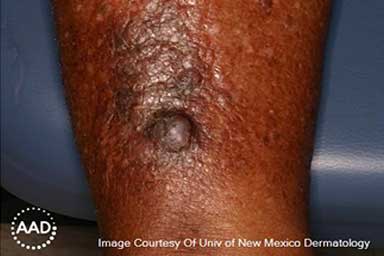 Round, firm, dark-brown growth on patient’s skin is basal cell carcinoma | American Academy of Dermatology