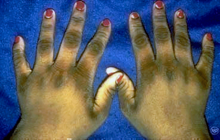 Acanthosis nigricans on 15-year old girl's hands