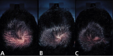 three photos showing a man's head before and after finasteride treatment