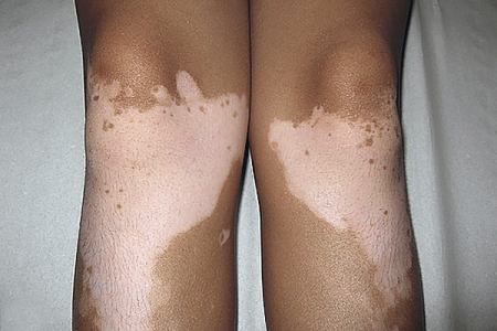 Non-segmental vitiligo