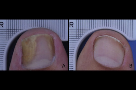 Image A: Before treatment for nail fungus; Image B: Complete clearing of nail one year after treatment with tavaborole.
