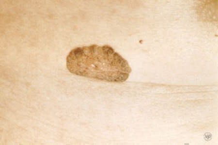 Close-up of seborrheic keratosis, a non-cancerous growth with a thick and warty surface.