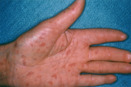 Visible blood vessels on palm of hand from scleroderma