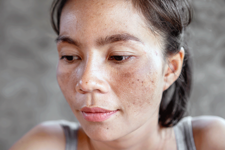 Woman's face having skin problem with dark spots