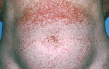 A patient with hives has widespread, raised welts