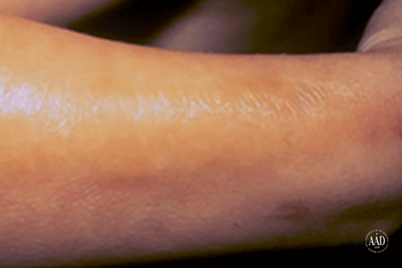 Scleroderma patches on arm