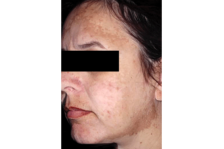 Woman with melasma on forehead and jawline