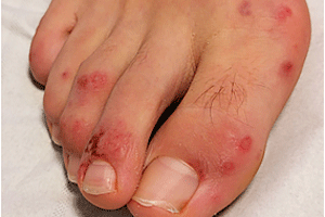 Coronavirus rash on patient’s foot