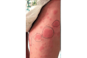 Coronavirus rash on patient’s leg