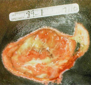 Card illustration for DWII on pressure ulcers