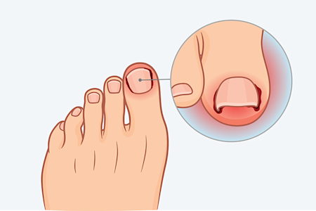 Illustration of ingrown nail