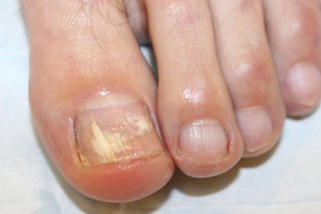 Nail fungus caused white and yellow discoloration on this toenail.