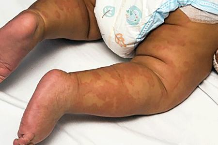 Baby with hives on legs.