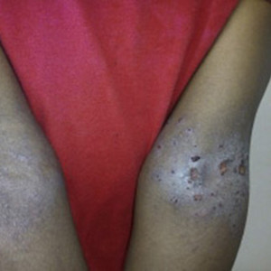 Card image of eczema, for DWII on the shortcomings of beef tallow as a treatment