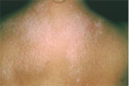 Scleroderma can cause a salt-and-pepper look to the skin