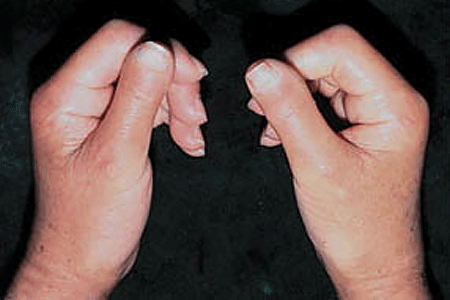 Woman is unable to straighten her fingers from diffuse cutaneous scleroderma