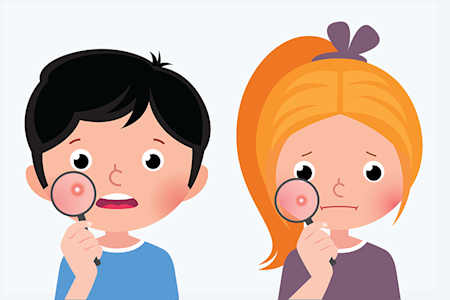 What kids should know about pimples. Landing page image of boy and a girl having pimples.