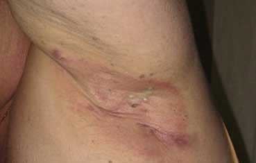 Hidradenitis suppurativa on the underarm