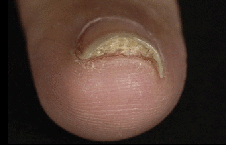 debris beneath the nail due to nail psoriasis