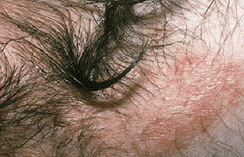 Inverse psoriasis of scalp