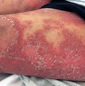 Card image for DWII on steroids and psoriasis