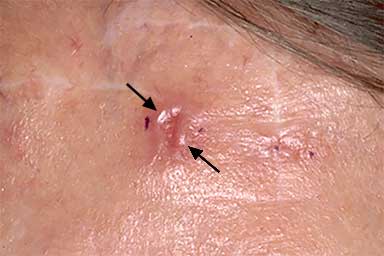 Pinkish, red dip with raised borders is basal cell carcinoma | American Academy of Dermatology