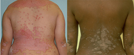 psoriasis on back of white woman and black woman