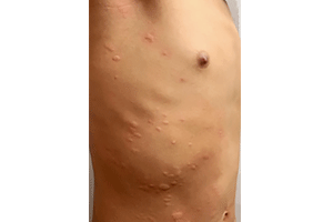 Coronavirus rash looks like hives