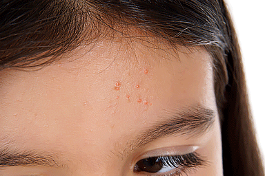 Molluscum contagiosum on the forehead of a young girl