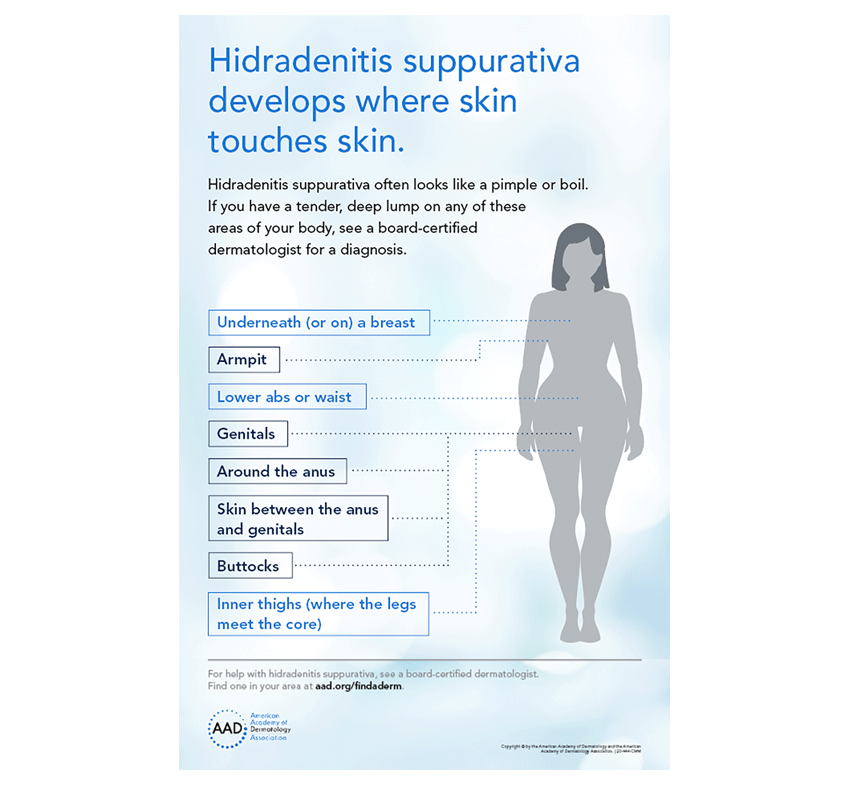 Infographic of where hidradenitis suppurativa can develop on the skin.